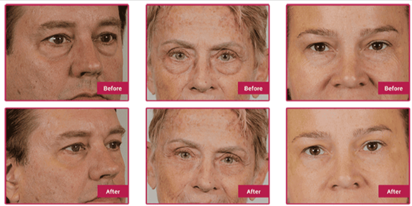 Cyabags Before After