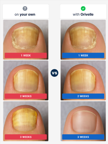 Orivelle Fungus Pen popular