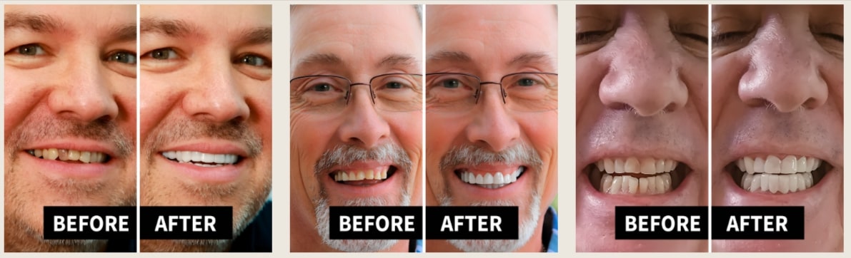 Shiny Smile Veneers-Results