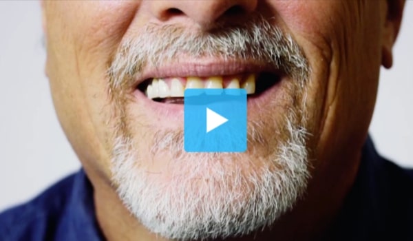 Shiny Smile Veneers Reviews